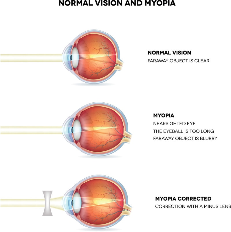How to Clear Your Sight: Solutions for Refractive Vision Problems