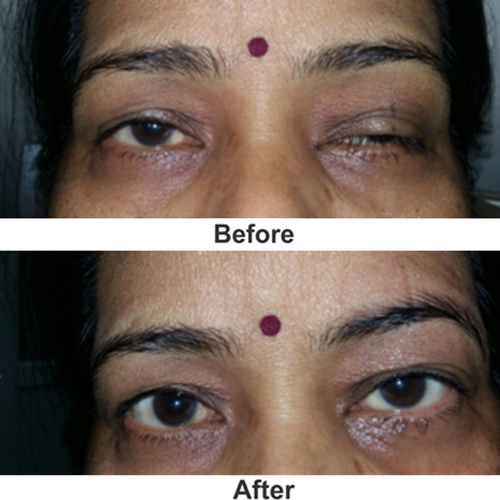 Is Oculoplasty Right for You? Signs You Might Need Eye Surgery